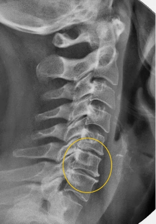Gimdos kaklelio stuburo osteochondrozė